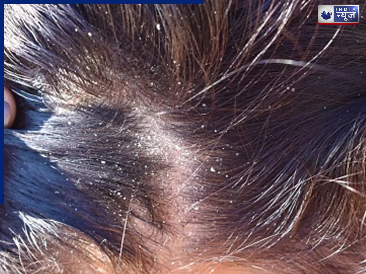 Dandruff increases - Photo Gallery