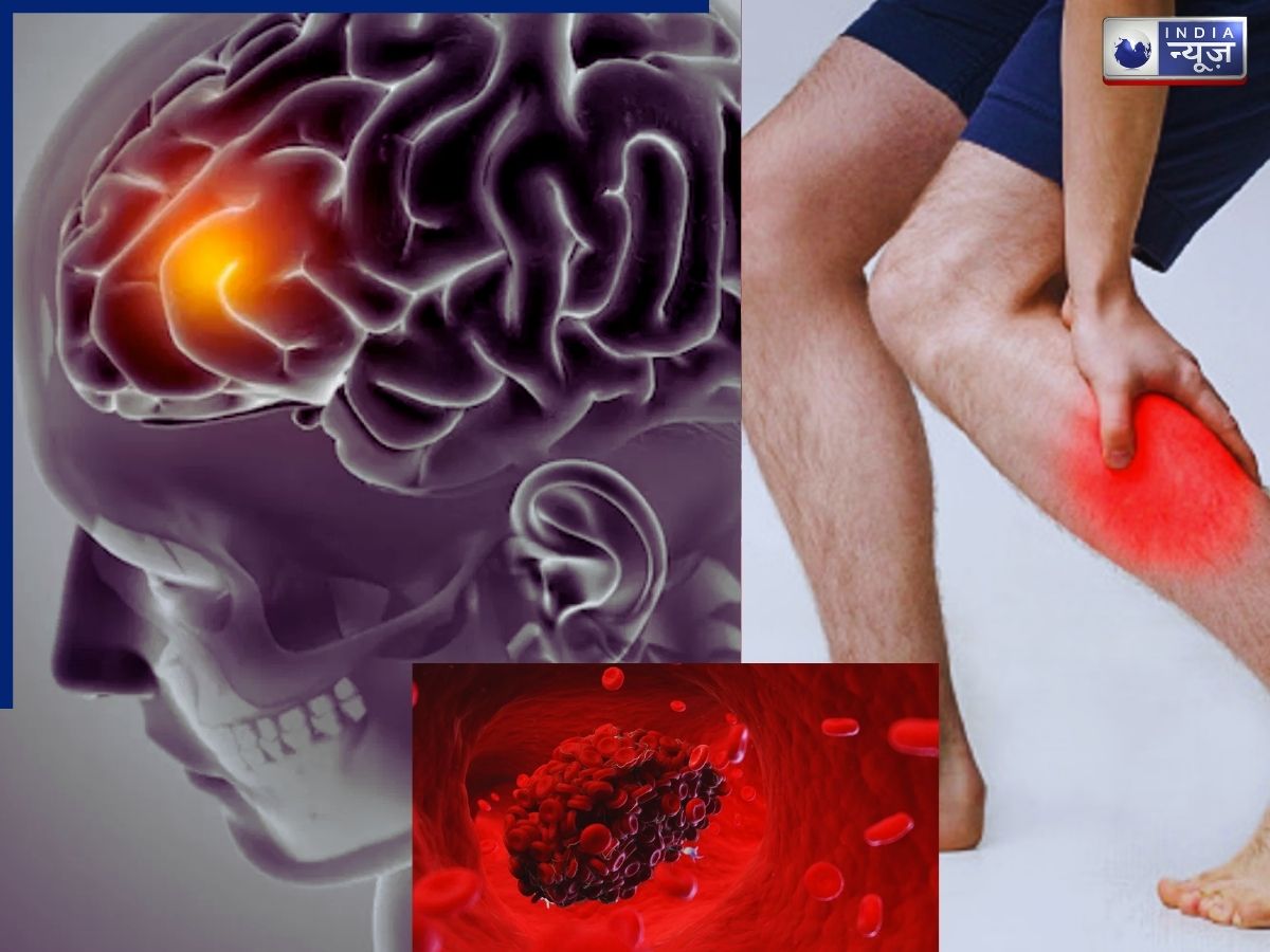 Causes of Blood Clots: सलीम खान को हुई बीमारी ब्लड क्लॉट क्या है, जानें इसके लक्षण और सावधानियां?