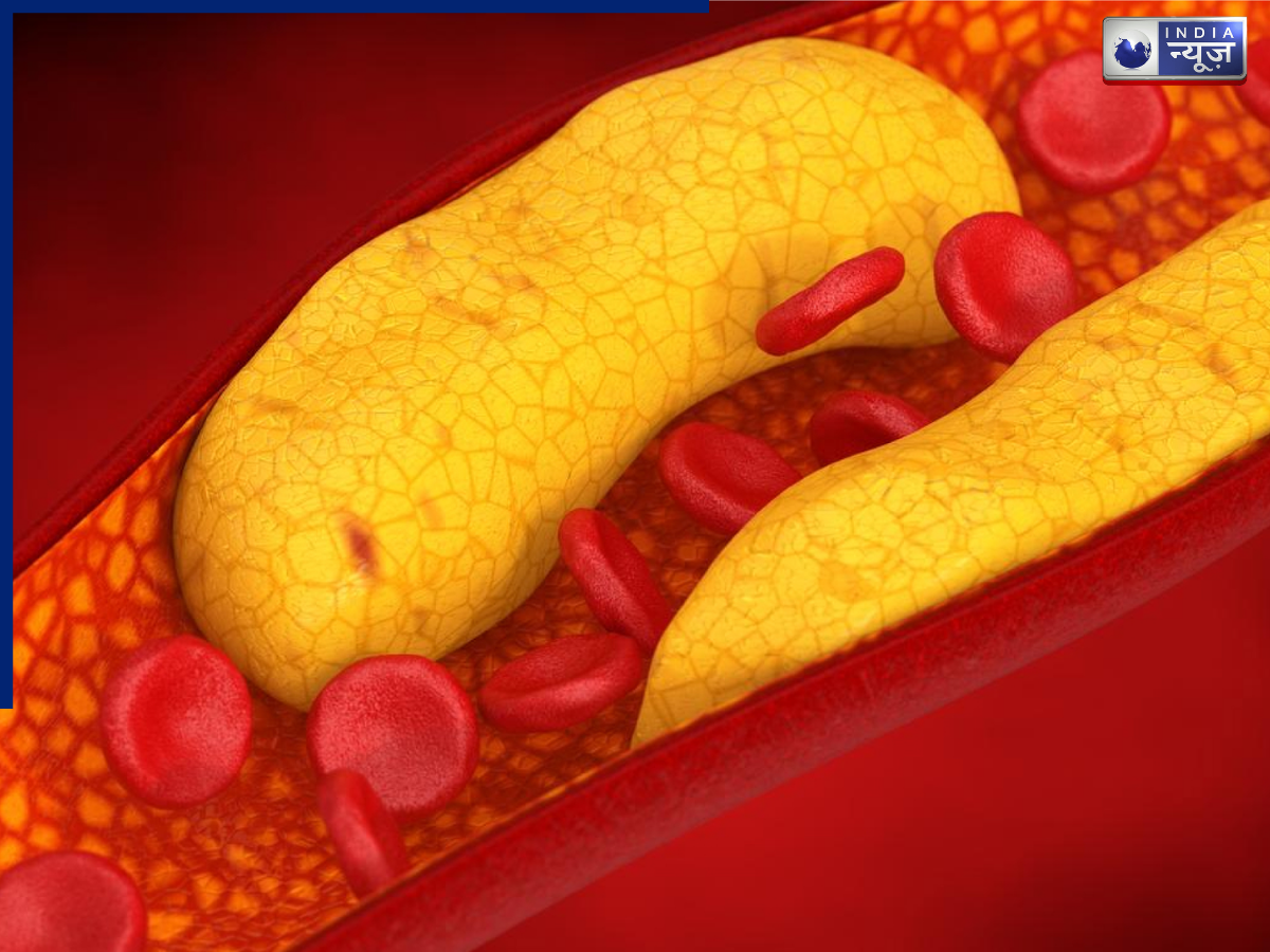 Lipoprotein is a silent killer - Photo Gallery