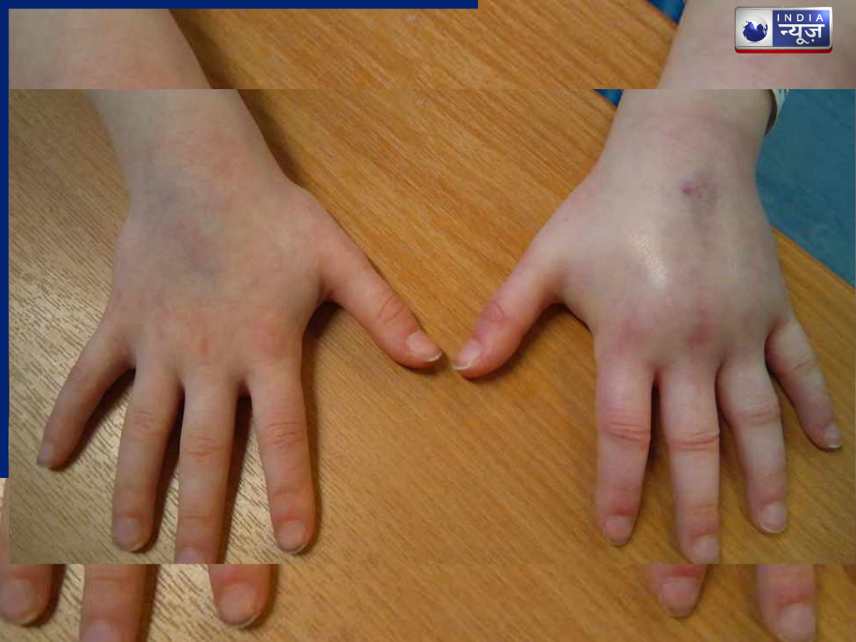 When does nephrotic syndrome occur? - Photo Gallery