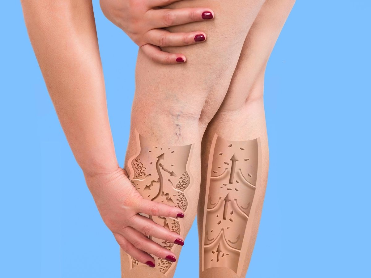 Signs of poor blood flow - Photo Gallery