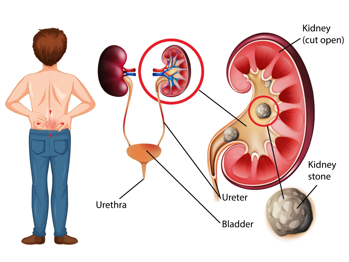 How Are Kidney Stones Formed - Photo Gallery