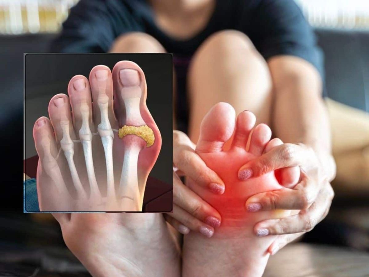 Why is uric acid level increasing? - Photo Gallery