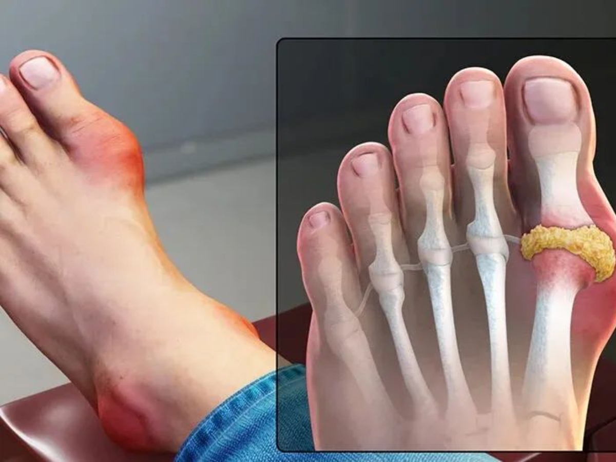 Why is uric acid level increasing? - Photo Gallery