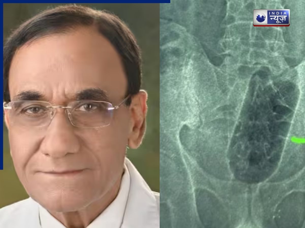 प्राइवेट पार्ट में घुसा ली बोतल, 36 घंटे तक तड़पा, सर्जरी करने के बाद डॉक्टर ने किया चौंकाने वाला खुलासा