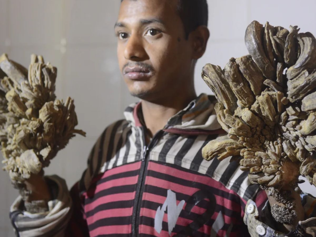 epidermodysplasia verruciformis - Photo Gallery