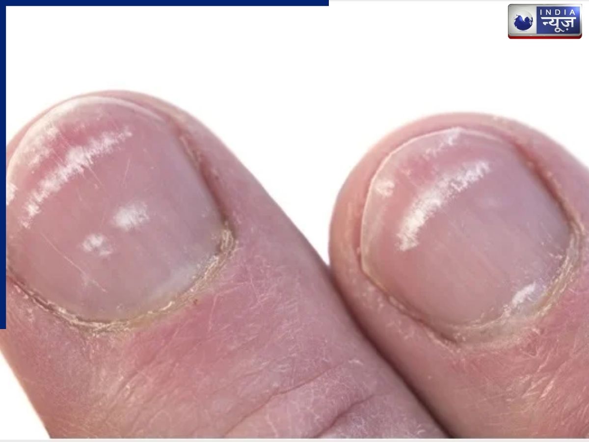 नाखूनों पर सफेद निशान क्यों होते हैं? ये छोटे संकेत बड़ी समस्या बता सकते हैं, एक्सपर्ट ने बताई वजह