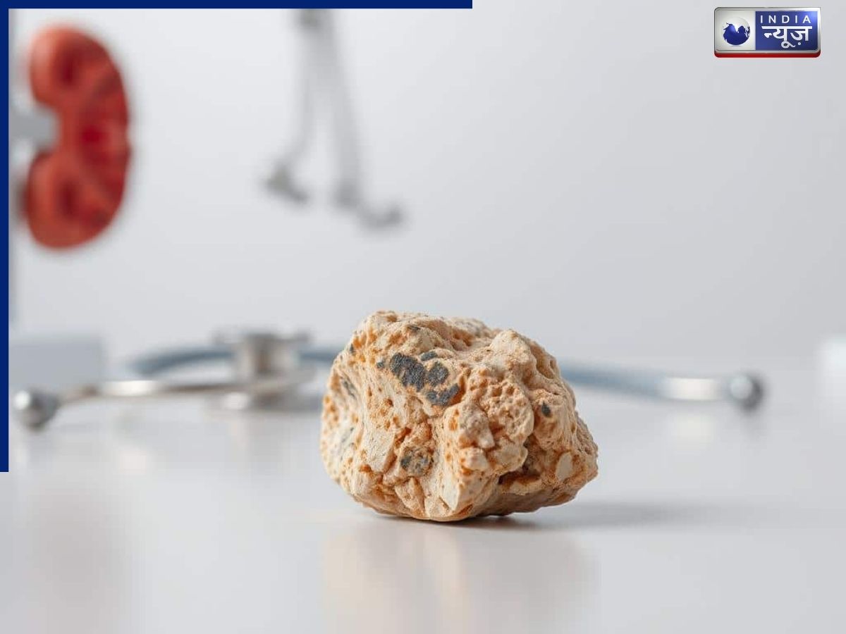 किडनी में बार-बार क्यों हो जाता है स्टोन? इन चीजों से परहेज से कर सकते हैं बचाव
