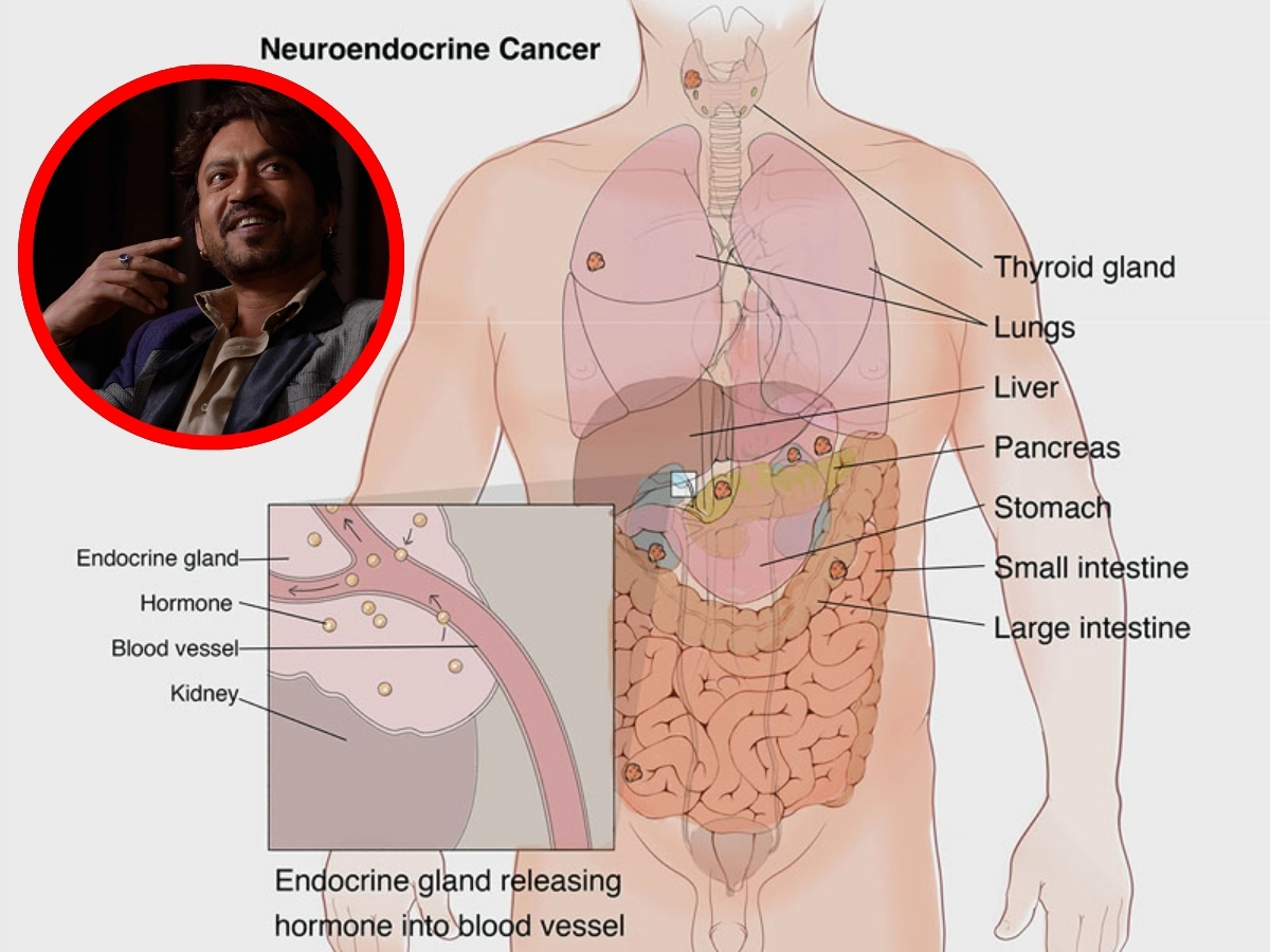 क्या है न्यूरोएंडोक्राइन ट्यूमर, जिसके कारण हुई थी इरफान खान की मौत? जानें कारण और इलाज