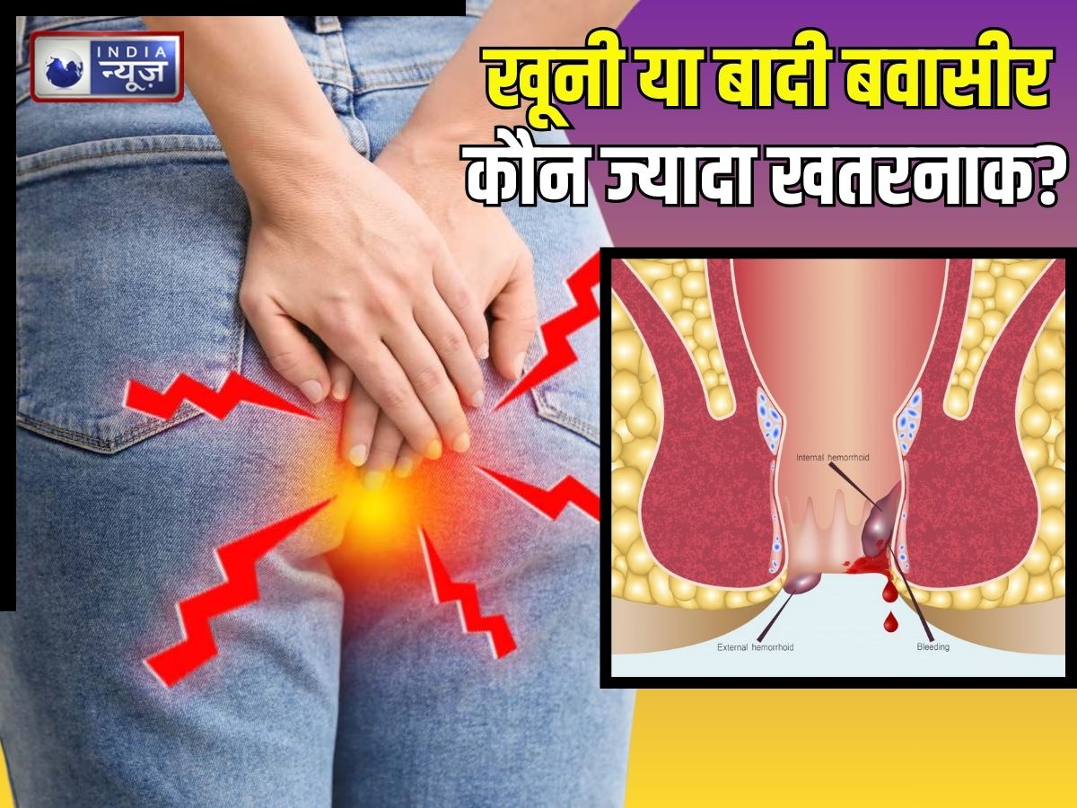 Piles Cure: खूनी या बादी… कौन सी बवासीर ज्यादा खतरनाक? कैसे होती बीमारी की शुरुआत, किन चीजों का करें परहेज