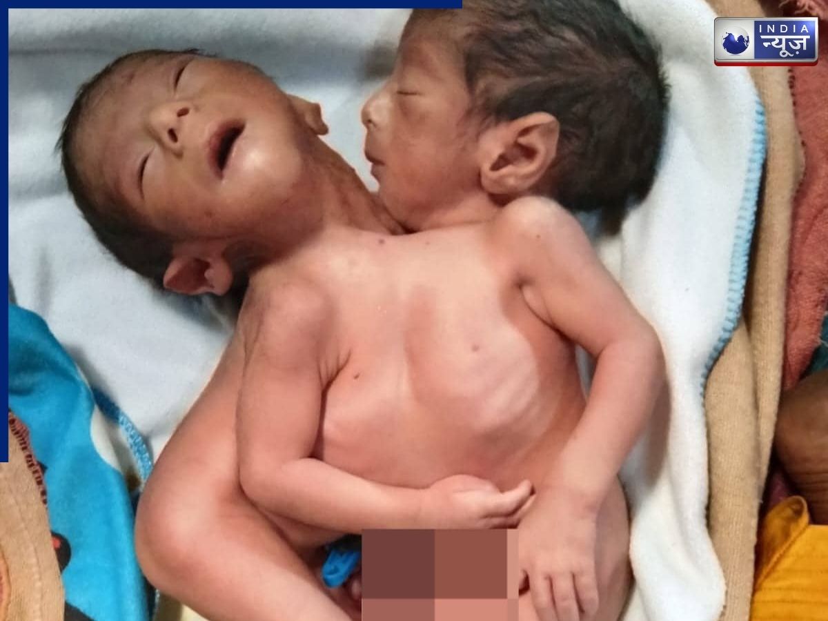 UP Rare Birth: 2 सिर, 4 पैर और उल्टा दिल! मौत को मात देकर जन्मा बच्चा, लेकिन सिर से उठ गया ममता का आंचल