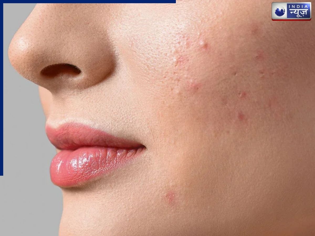 मुंहासों से छुटकारा कैसे पाएं, स्किन एक्सपर्ट ने दिए ये टिप्स, अपनाएं ये आसान तरीके