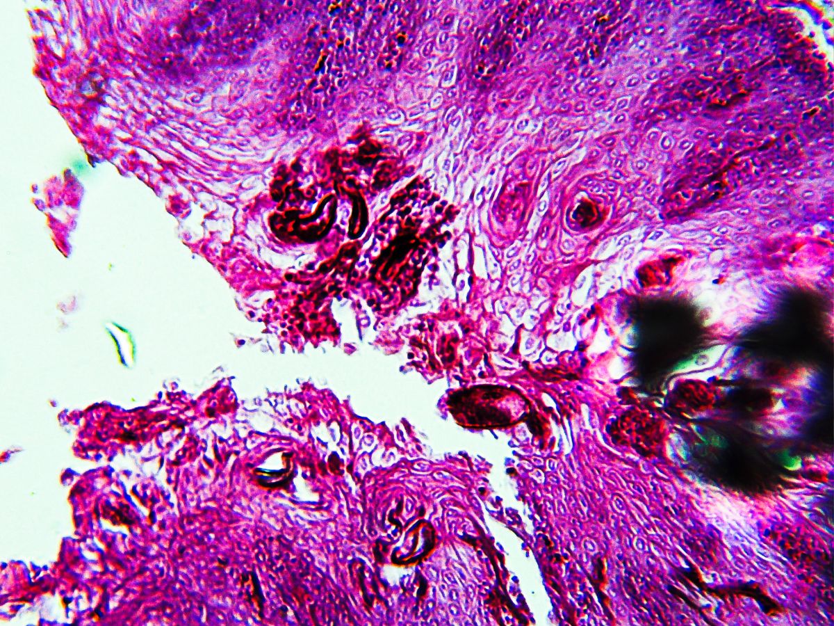 Xeroderma pigmentosum - Photo Gallery