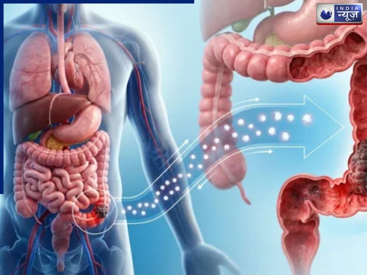 Colorectal Cancer: तेजी से फैलती बीमारी, कोलन कैंसर बना तीसरा सबसे आम कैंसर, क्या है लक्षण और कारण
