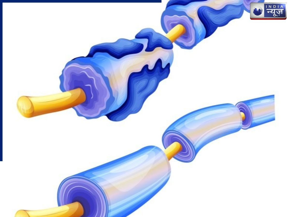 क्या है मल्टीपल स्क्लेरोसिस (MS)? आंखों की रोशनी पर असर से लेकर शुरुआती लक्षण तक जानिए सबकुछ