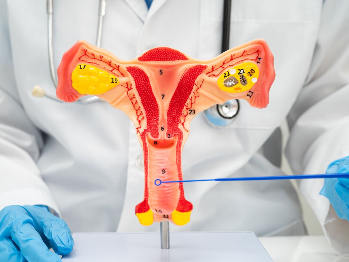 polyps in uterus - Photo Gallery