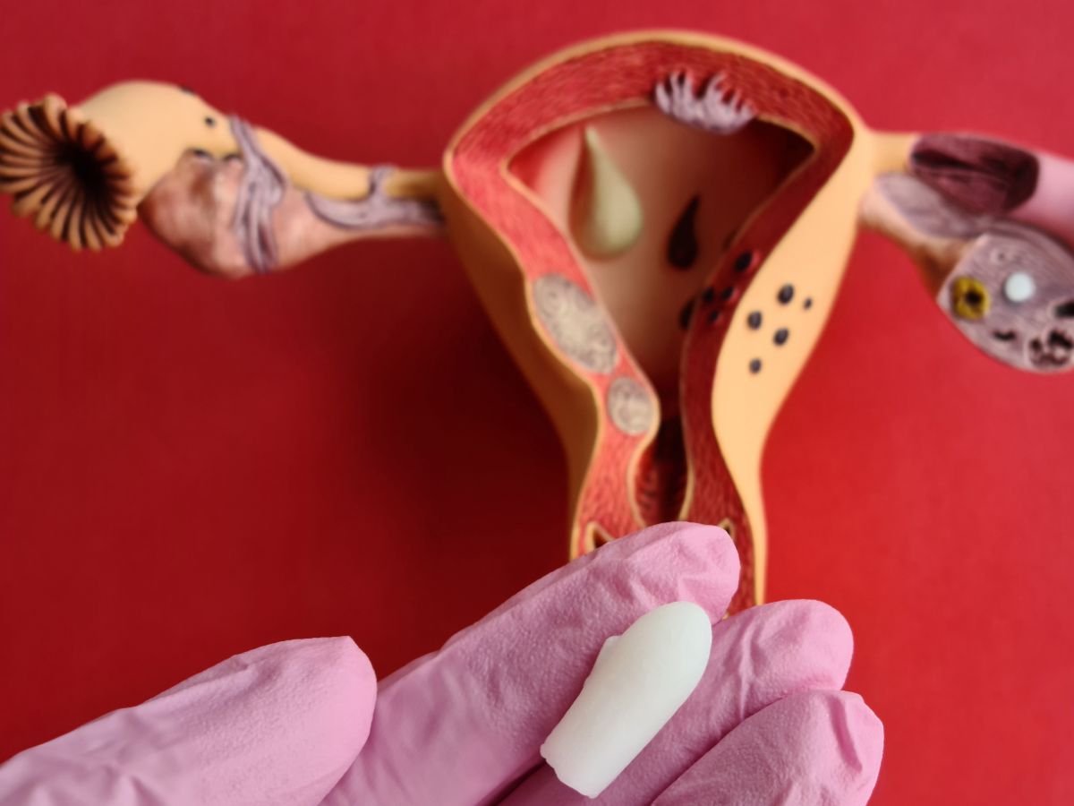 Uterus Cancer - Photo Gallery