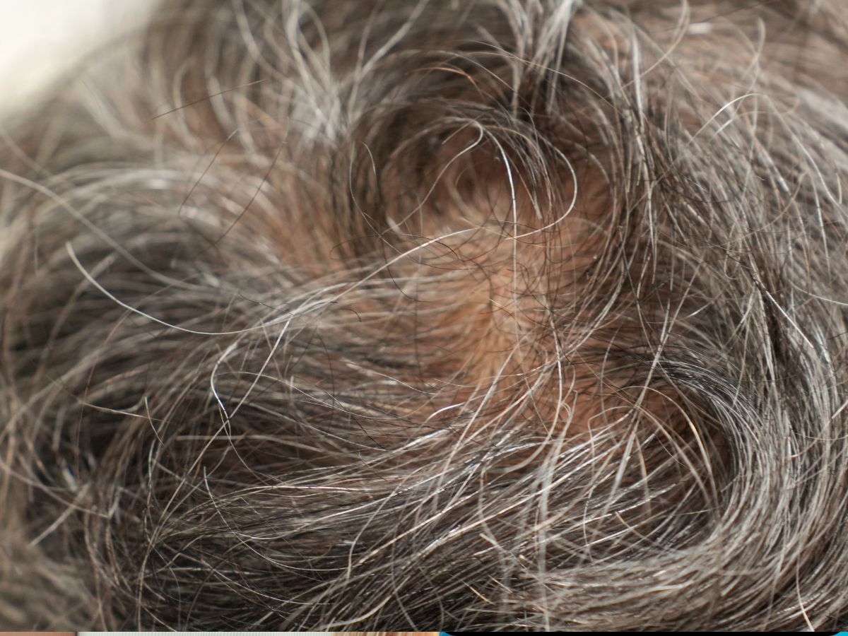 White hair problem - Photo Gallery