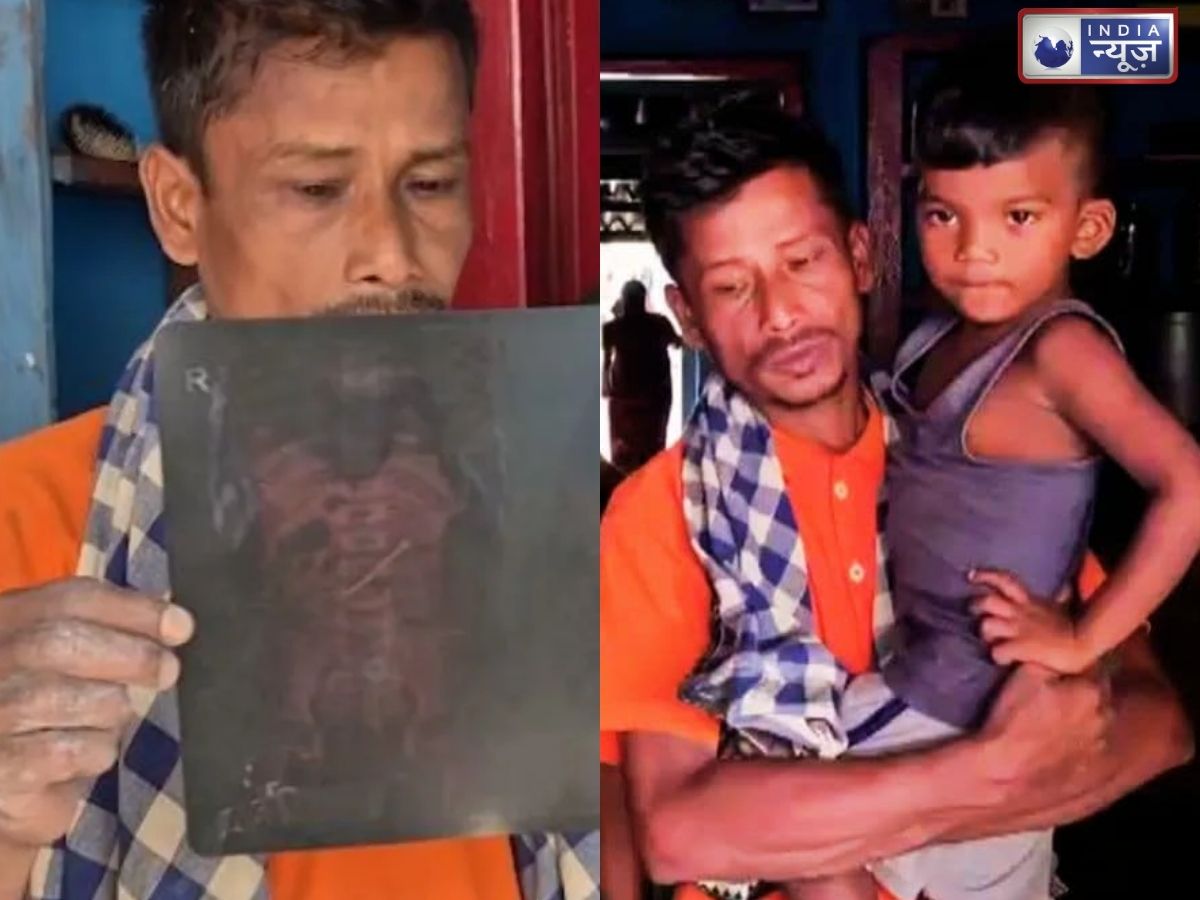 28 दिन से पेट में फंसी लोहे की कील, दर्द में करहाता रहा 3 साल का मासूम; परिवार लगा रहा इलाज की गुहार