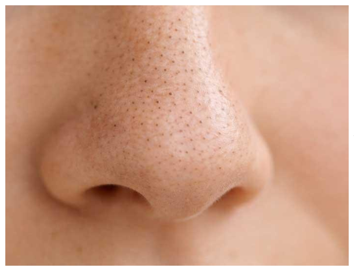 Are the black spots on the nose blackheads? - Photo Gallery