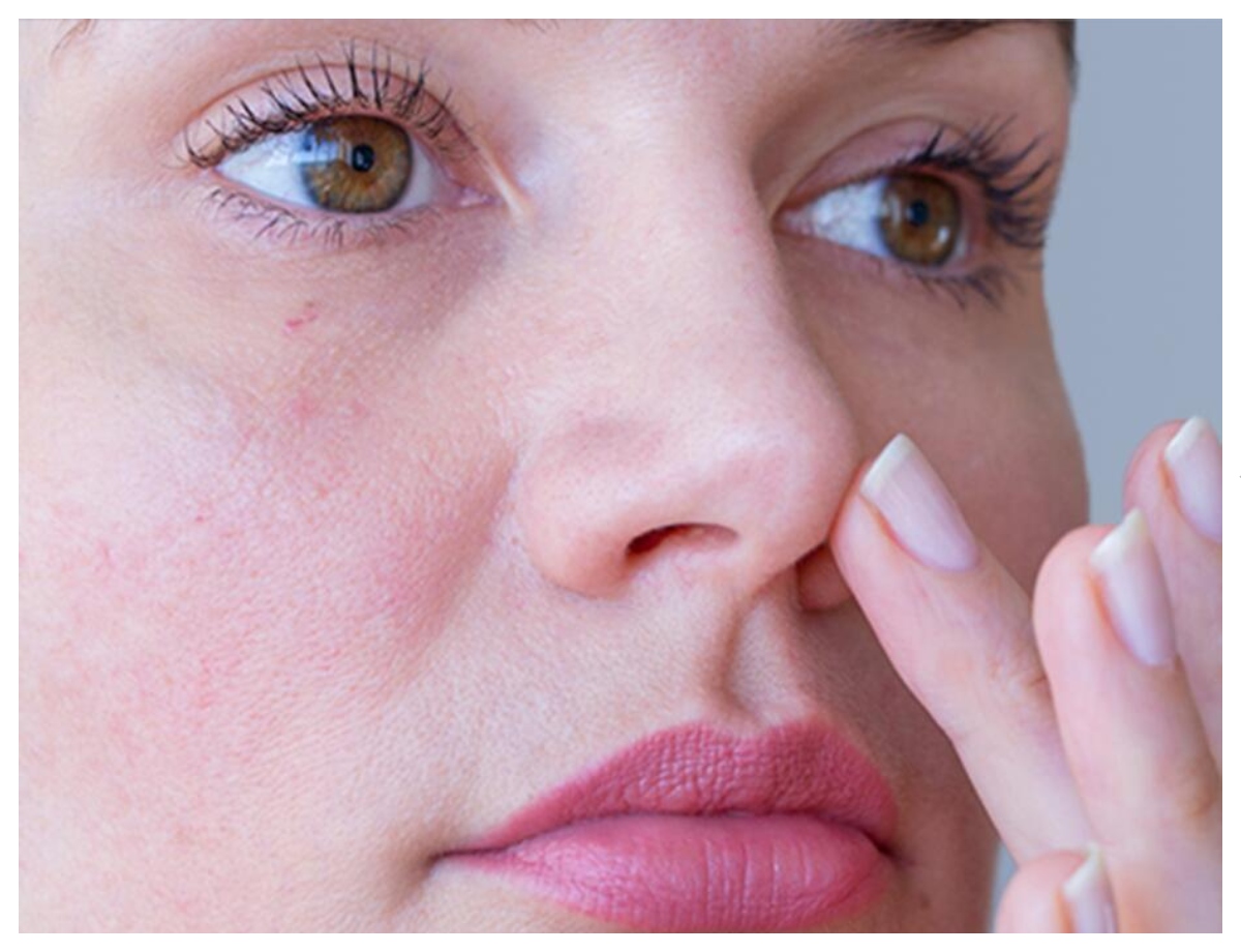 Why does inflammation occur in the nasal folds? - Photo Gallery