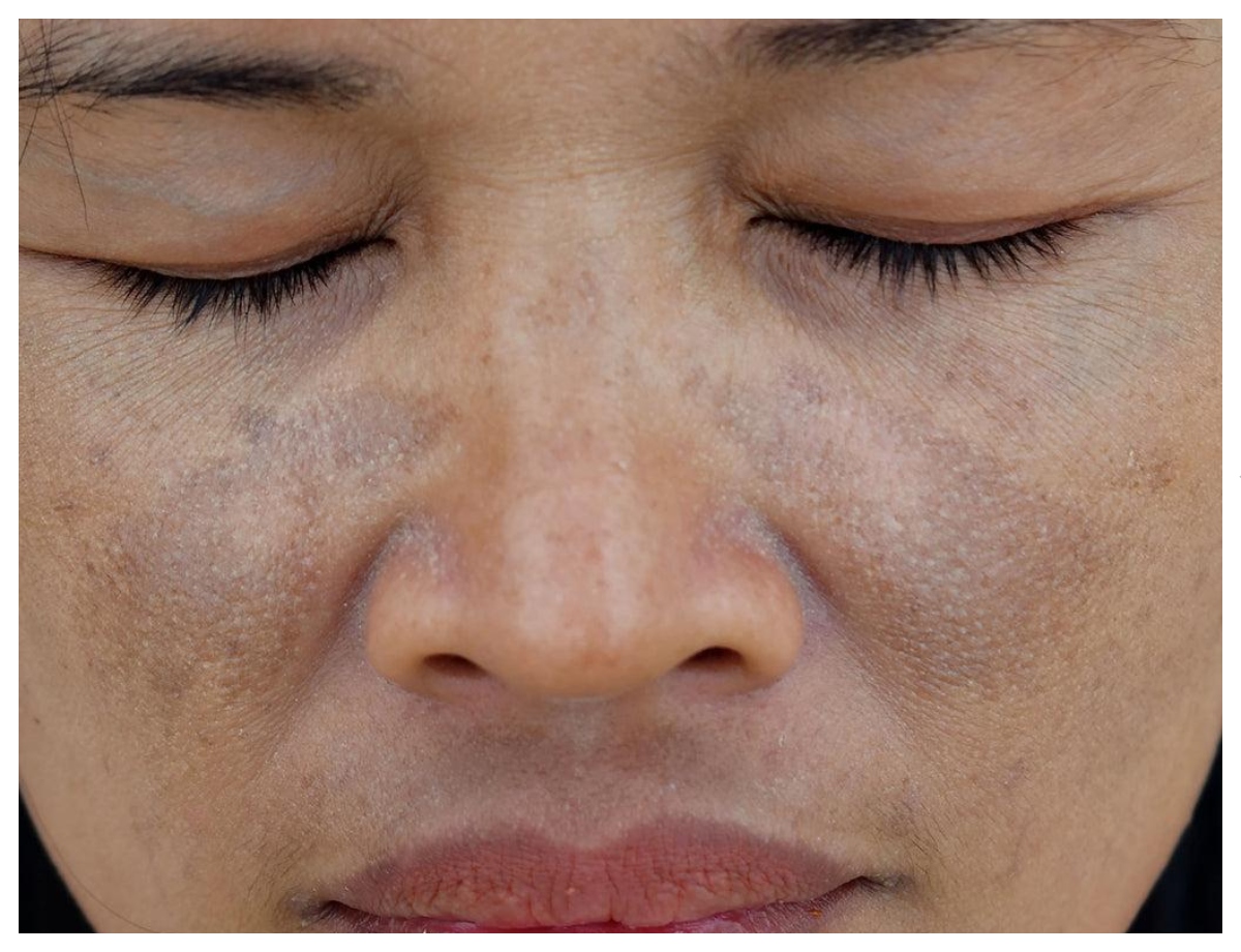 Why does blackness appear around the nose and mouth? - Photo Gallery